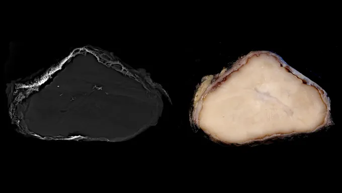 It masquerades as malignant. But this bone-covered tumor is benign